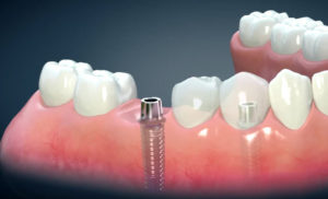 San Diego dental implants